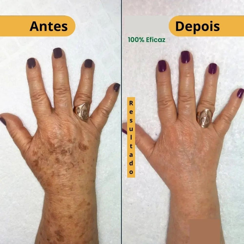ClareSkin 577 — Spray Removedor de Manchas, Sol, Idade e Melasma! 50% DE DESCONTO + FRETE GRÁTIS!
